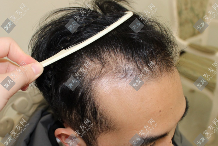 大麥植發(fā)3000個毛囊多少錢